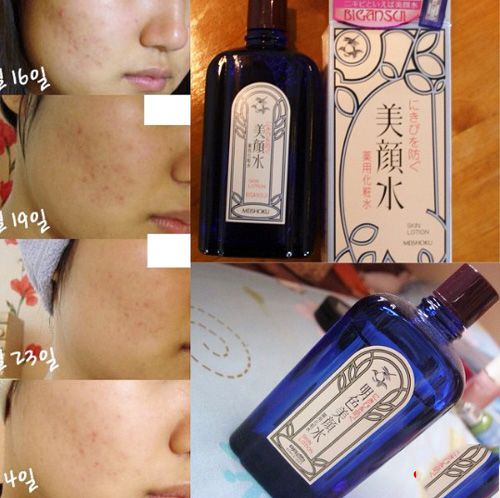  Nước Hoa Hồng Trị Mụn Meishoku Bigansui Medicated Skin Lotion - Khoedeptainha.vn